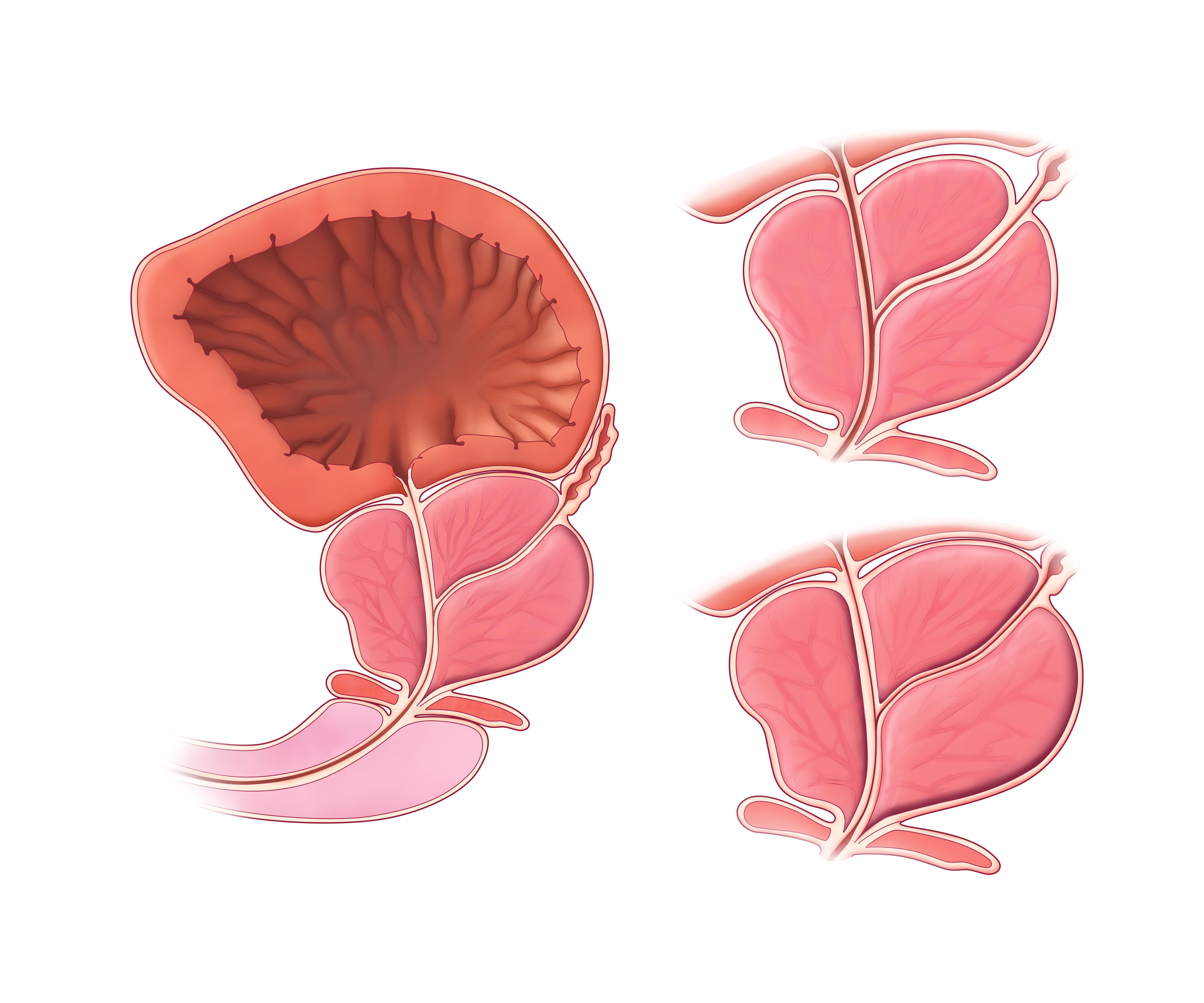 illustration of benign prostatic hyperplasia