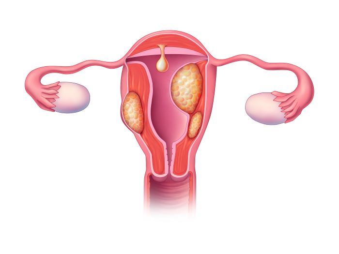 multiple fibroids in a uterus