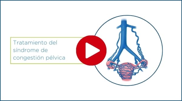 reproducir vídeo del tratamiento del síndrome de congestión pélvica