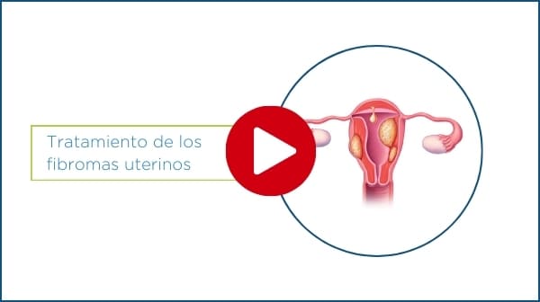 reproducir el vídeo sobre el tratamiento de los miomas uterinos