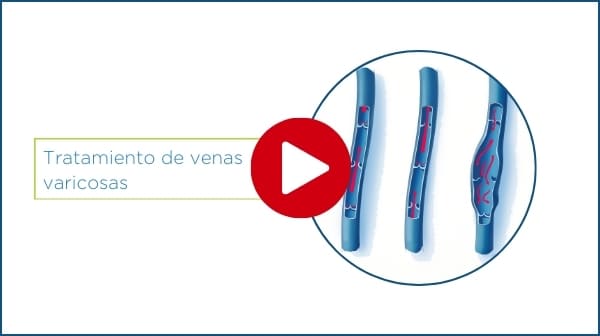 reproducir vídeo de tratamiento de varices