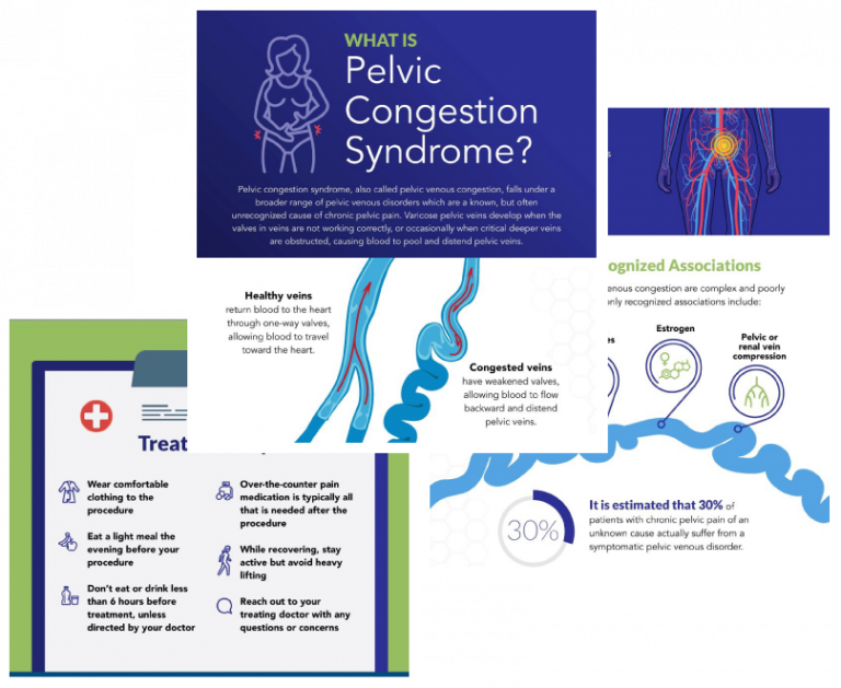 preview images of pelvic congestion syndrome infographic