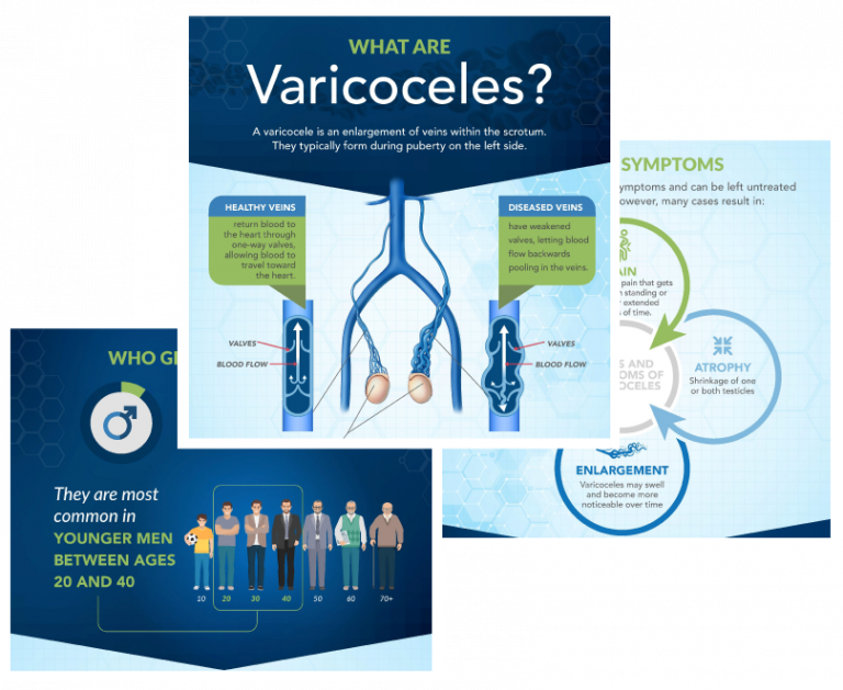 preview images of what are varicoceles infographic