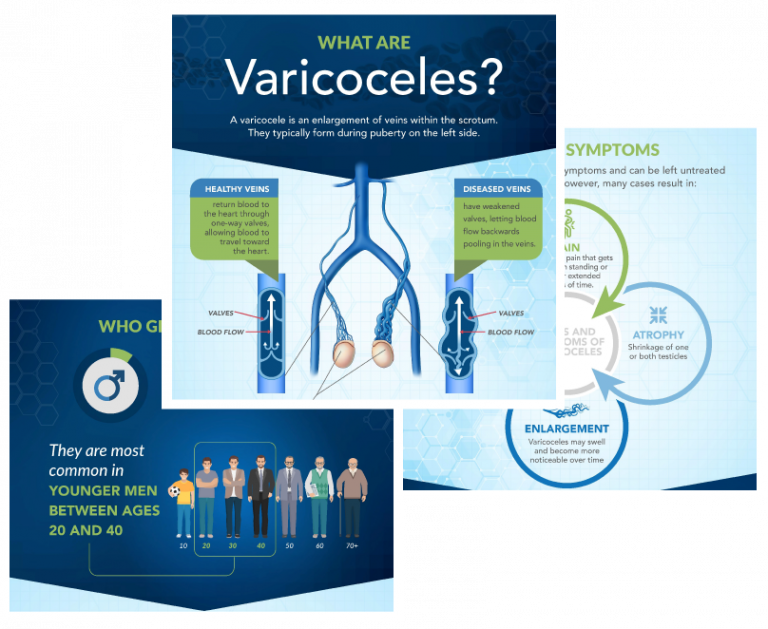 Varicocele Treatment