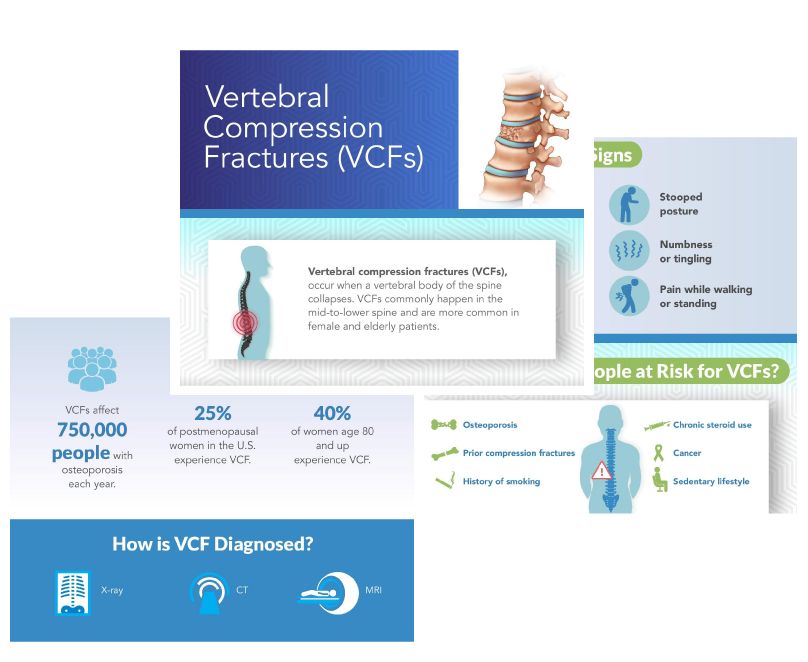 Compression Fracture Treatment IVC