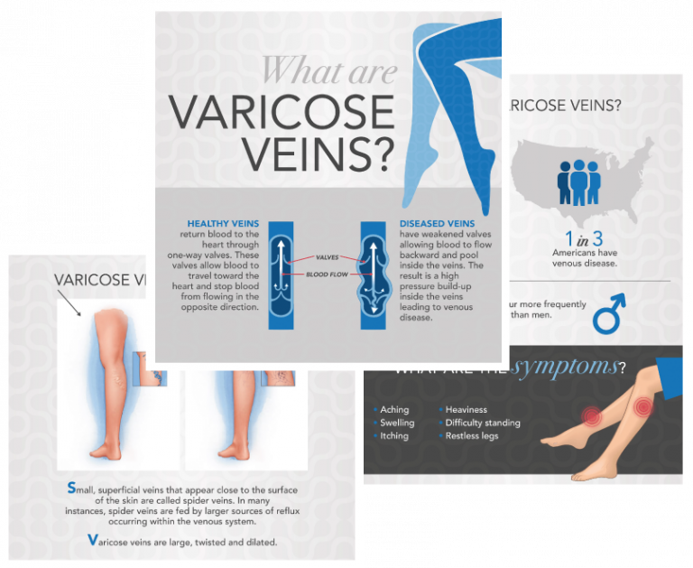 preview images of what are varicose veins infographic