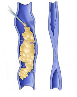 cross section of a vein being treated with sclerotherapy