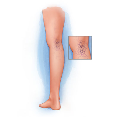 spider veins or telangiectasia behind a knee