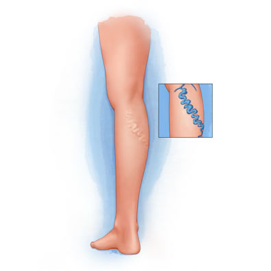 Bulging varicose veins in a leg